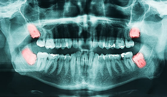 X-ray of impacted wisdom teeth